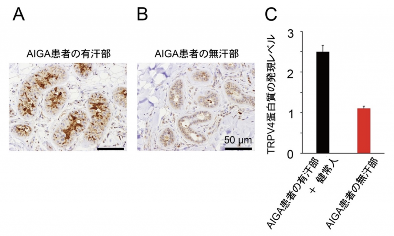 図4. ヒト汗腺でのTRPV4蛋白質の発現量

同じ特発性後天性全身性無汗症 (AIGA) 患者の有汗部（A）の方が無汗部（B）より強いTRPV4蛋白質の発現が認められます。AIGA患者の有汗部と健常人の汗腺の方がAIGA患者の無汗部よりTRPV4蛋白質の発現レベルが高いことが分かりました。
